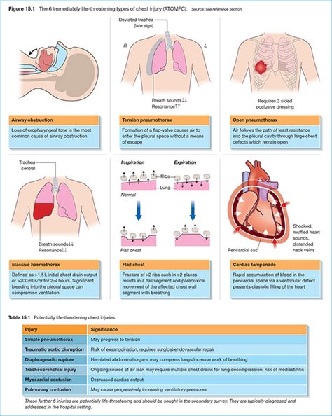 chest compression test trauma|positive airway pressure chest trauma.